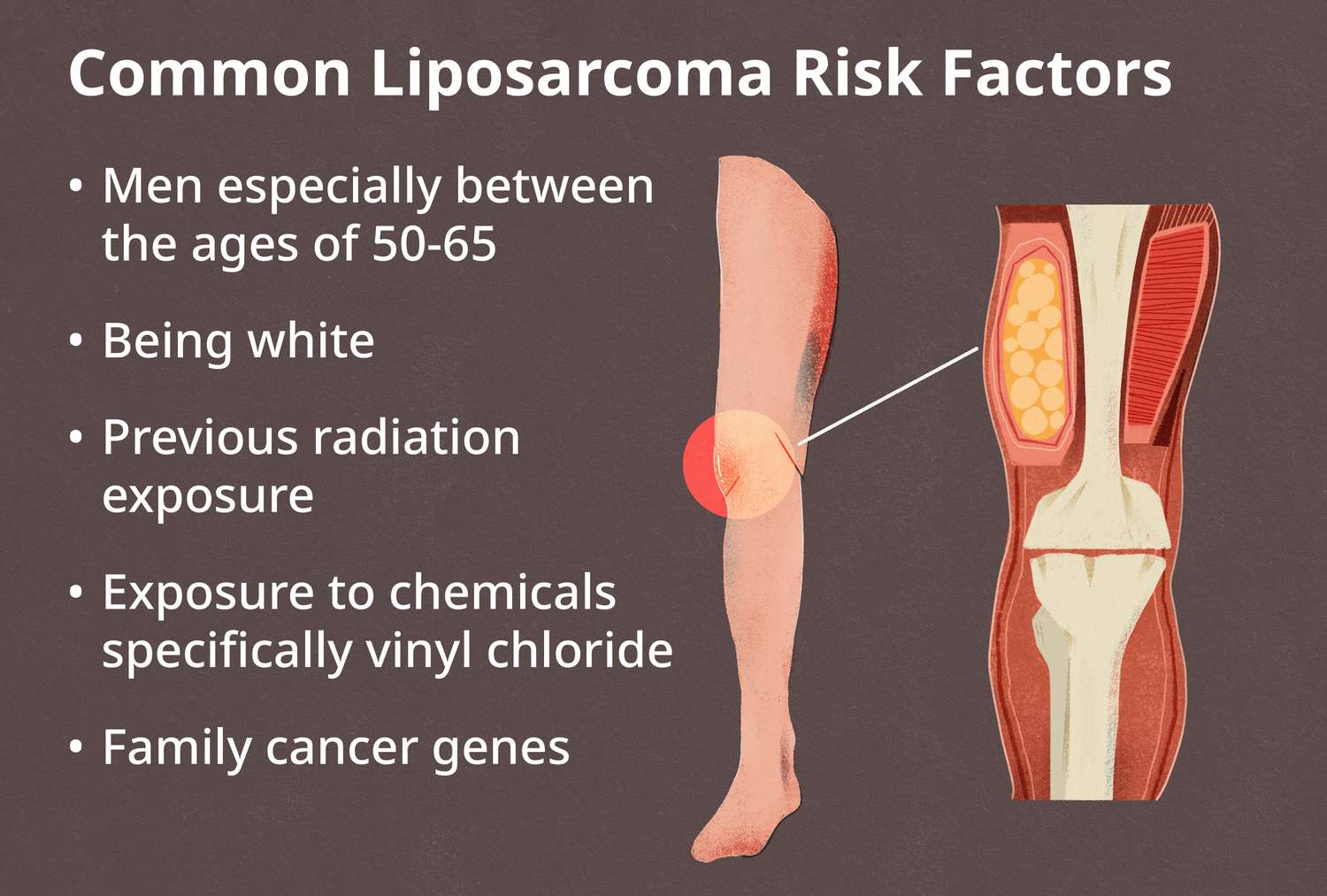 Liposarcoma ribbon