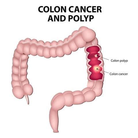 Colorectal Cancer ribbon