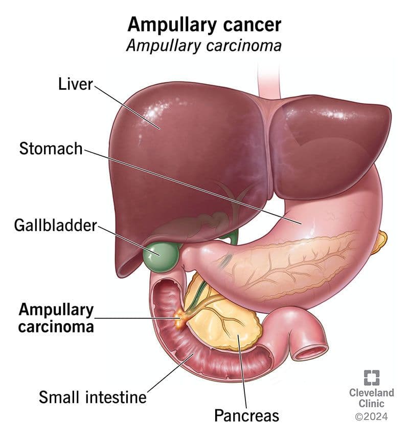 Ampullary Carcinoma ribbon