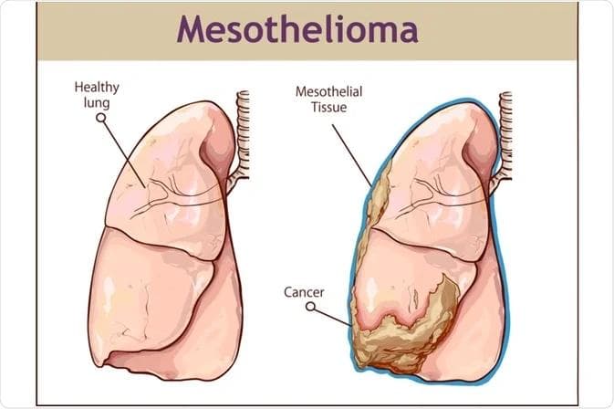 Mesothelioma ribbon