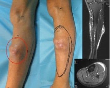 Myxofibrosarcoma ribbon